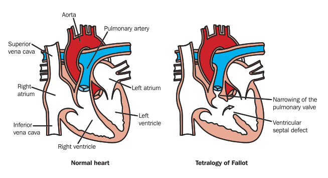 Tetralogy of Fallot | Maximum Fun